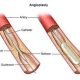 angioplasty angioplasty